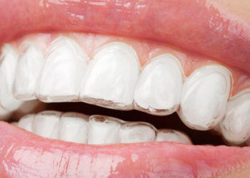 ortodonzia-invisalign-3